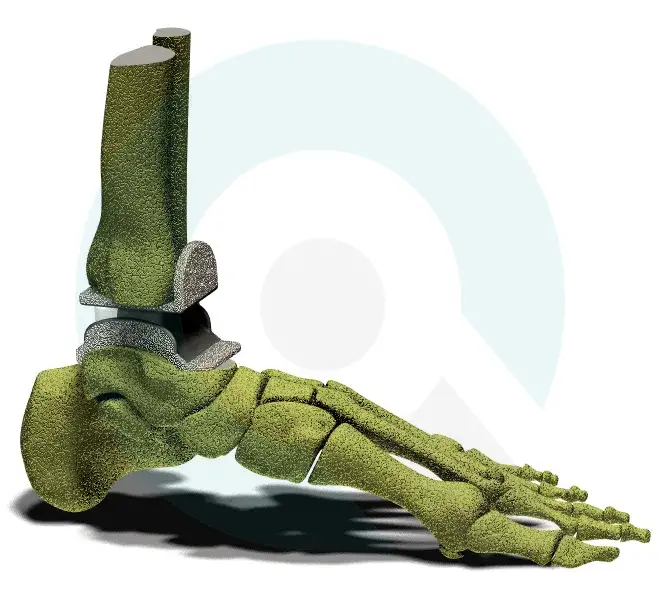An example of an ankle endoprosthesis.